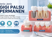 Gigi Hilang? Kenali Jenis-Jenis Gigi Palsu Permanen dan Pilihan Perawatannya